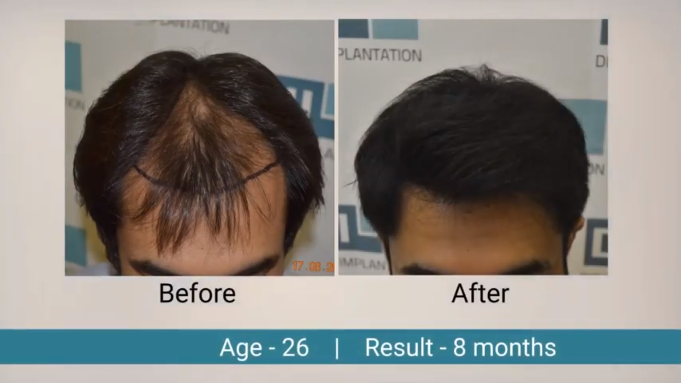 hair transplant video 1