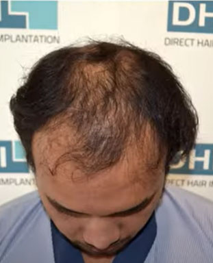 hair transplant video 1