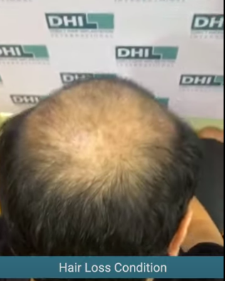 hair transplant video 1