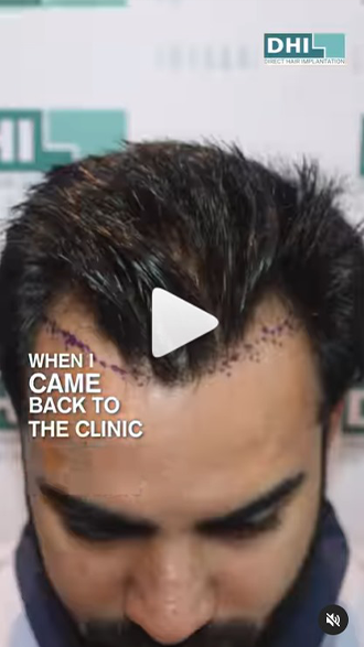 hair transplant video 1