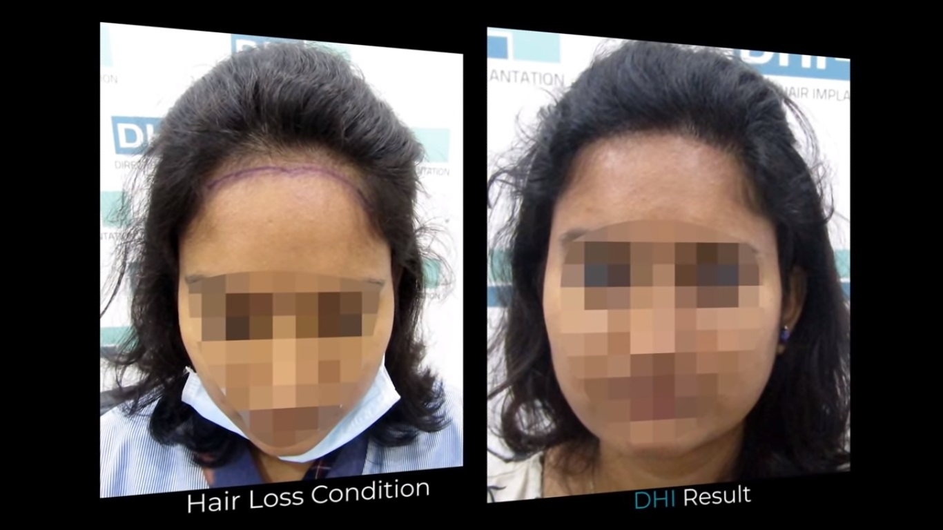 hair transplant video 1