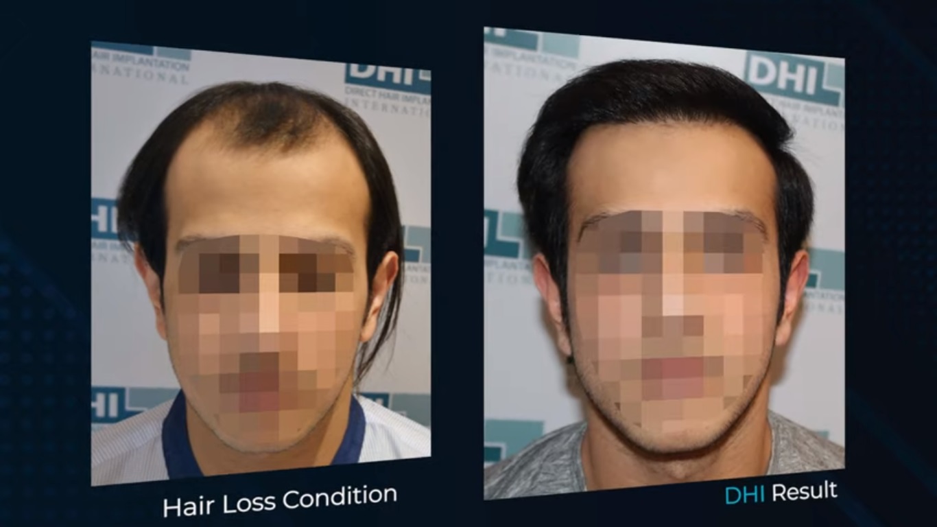 hair transplant video 1