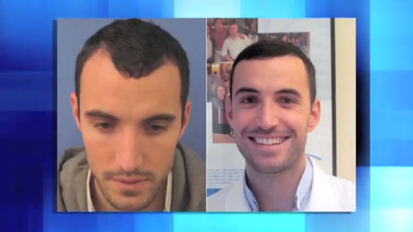 hair transplant video 1