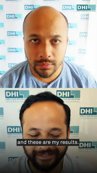 hair transplant video 1