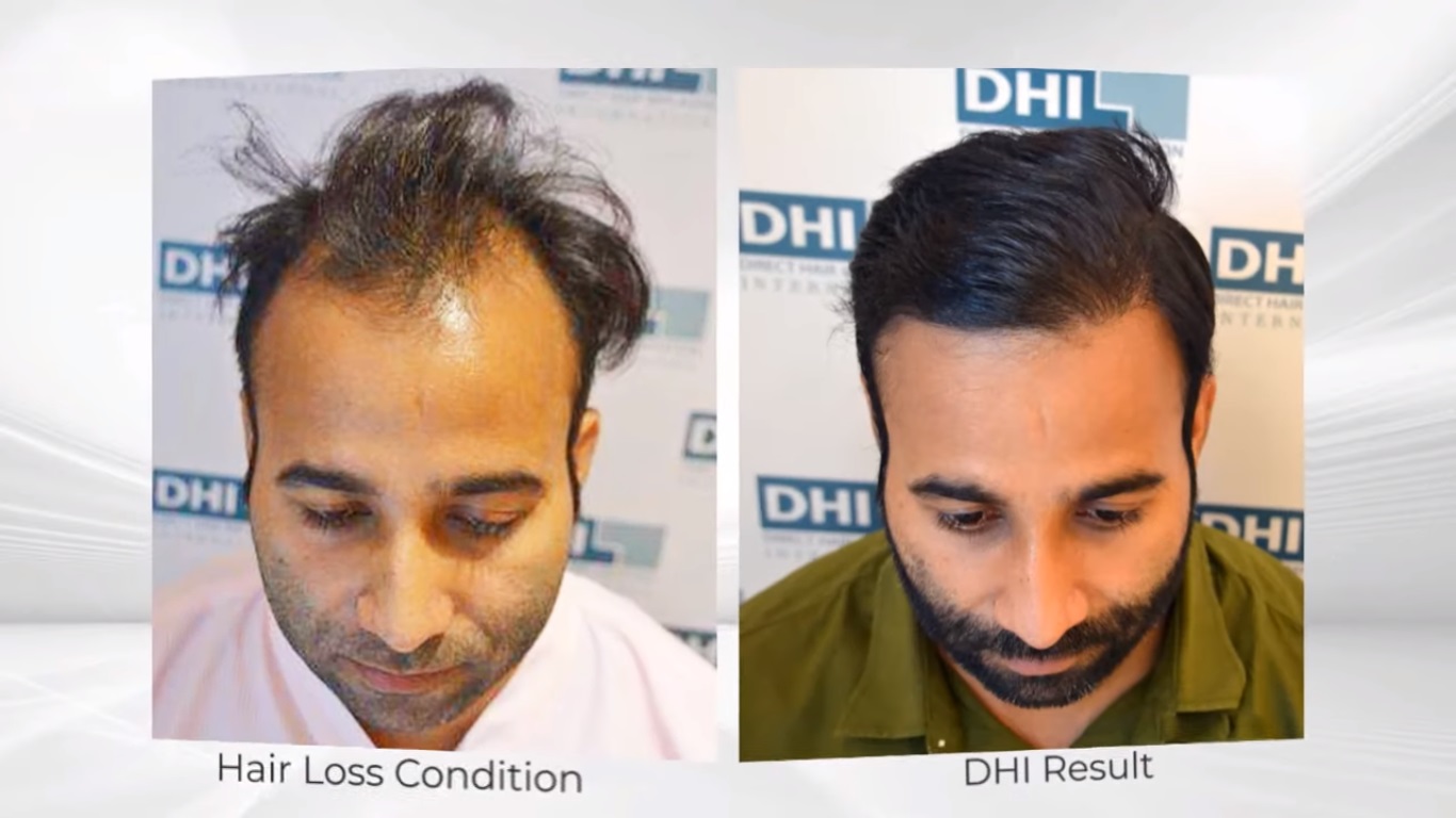 hair transplant video 1