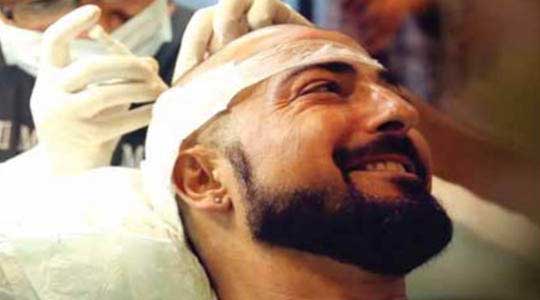 best hair transplant in jaipur