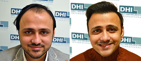 Best Hair Transplant in Delhi | Hair Transplant Surgeons In Delhi | DHI™  India