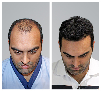Chandigarh hair transplant clinic