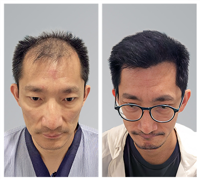Gurgaon hair transplant clinic