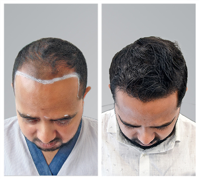 Kochi hair transplant clinic
