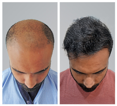 Lucknow hair transplant clinic