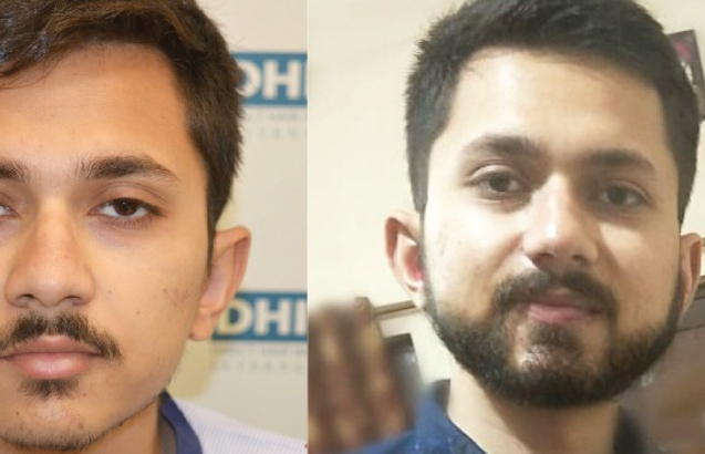 beard transplant clinic delhi client before after image