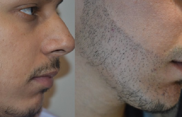 Facial Hair Restoration Beard Transplants And Alternatives  aren clinic