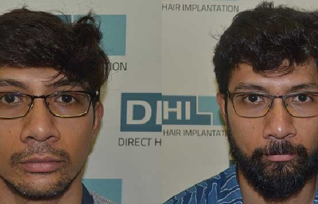 beard transplant delhi clinic client before after image
