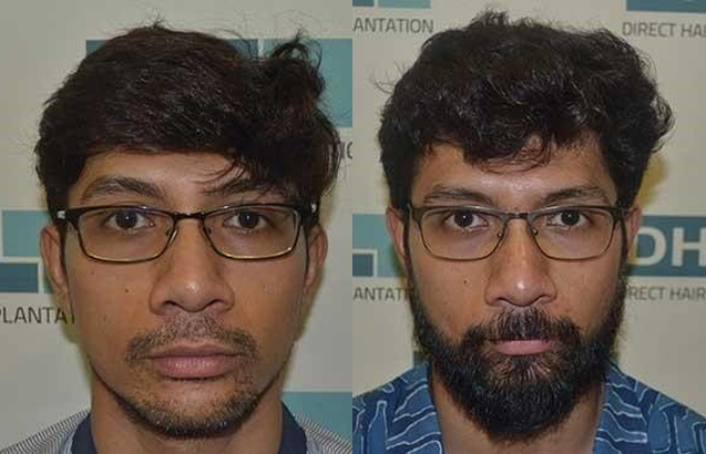 before and after hair transplant photo 3