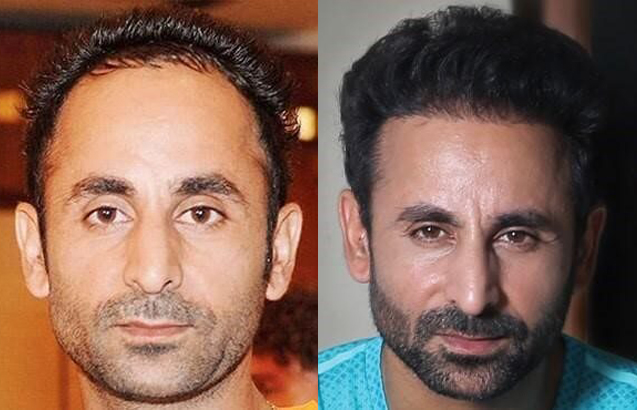 before and after hair transplant photo 4