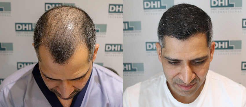 coimbatore hair transplant before and after case