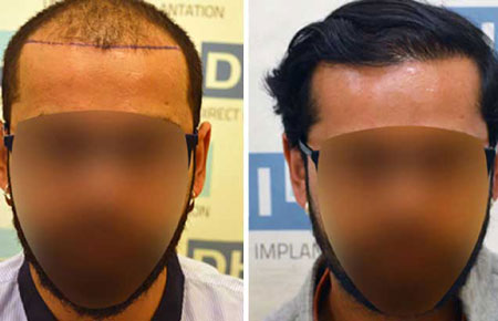 Hair Transplant Before & After Results