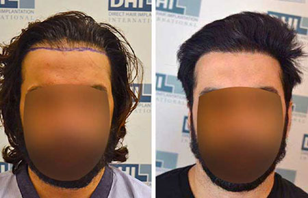 Delhi hair transplant before and after