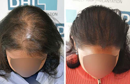 noida hair transplannt results