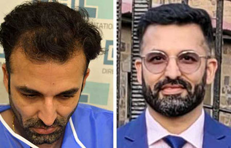 before and after hair transplant