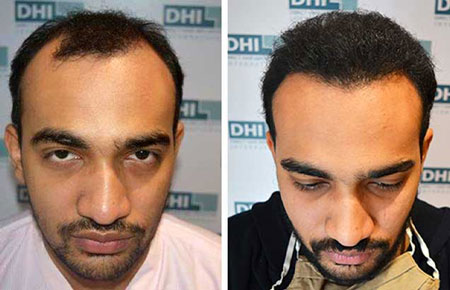 results showing before and after hair transplant treatment