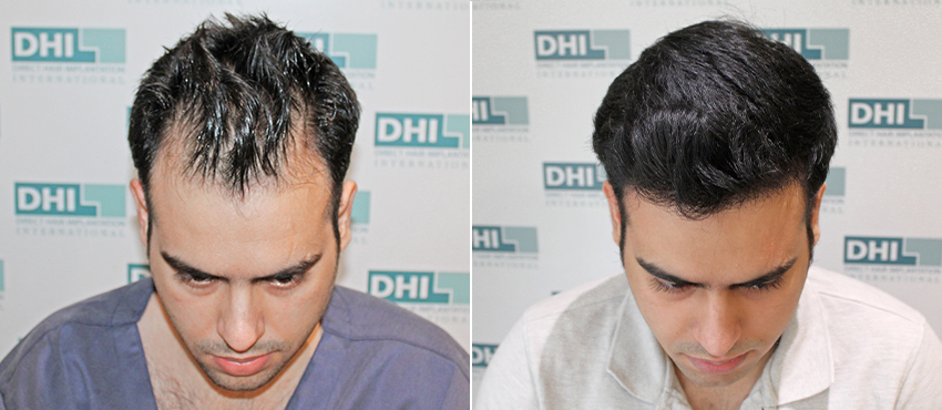 Hair transplant results Delhi