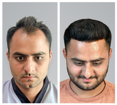 Mumbai hair transplant clinic