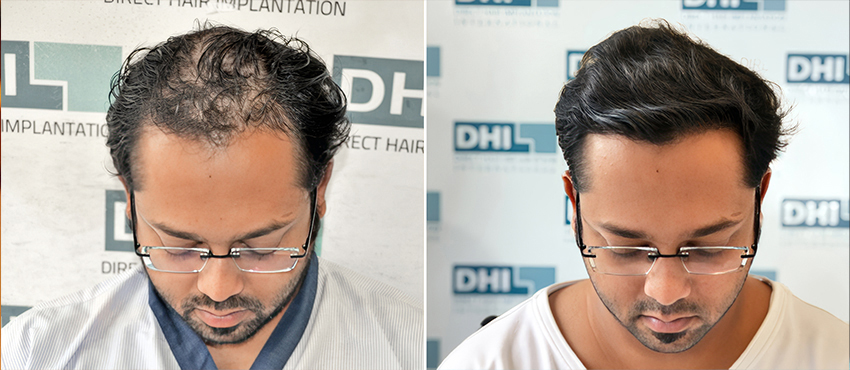 Hair Transplant Before & After Results in Mumbai