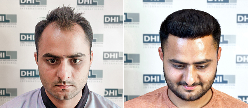 Before and after hair transplant results