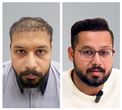 noida hair transplant clinic