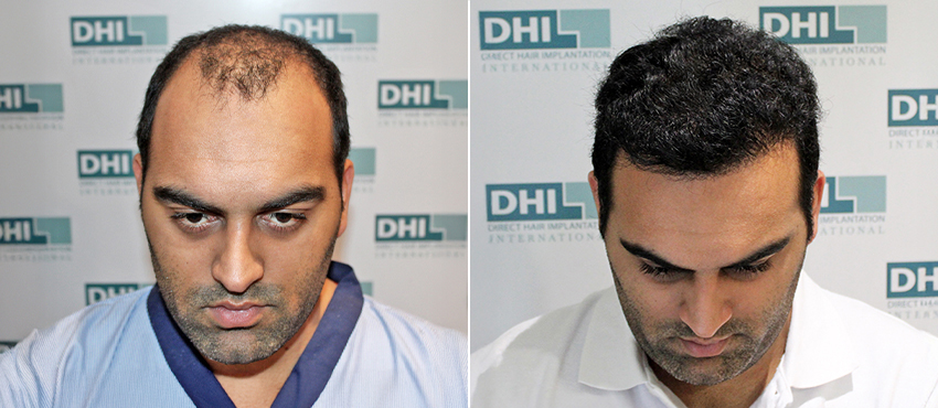 noida hair transplannt results