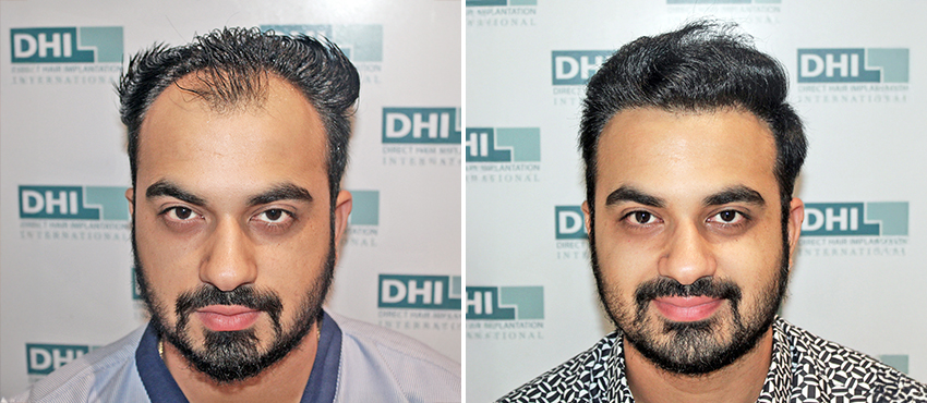 Before and after results of hair transplant treatment