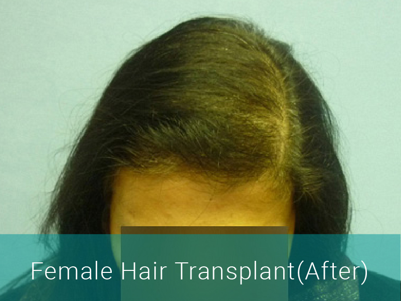 hair transplant medical tourism